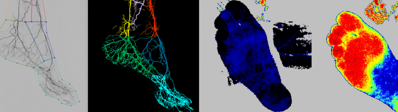 Quantified Perfusion assessment to guide and improve decision-making in treatment of Peripheral Arterial Disease