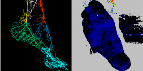 Quantified Perfusion assessment to guide and improve decision-making in treatment of Peripheral Arterial Disease