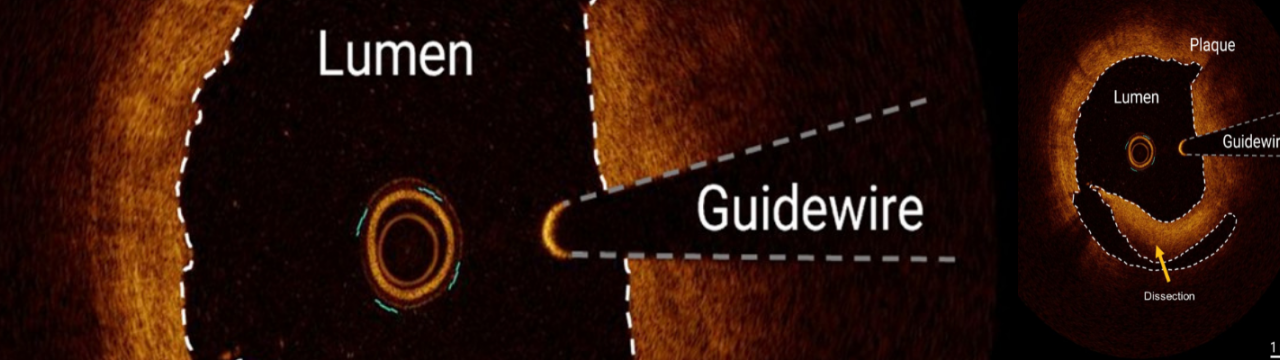 Optical Coherence Tomography for first-time right endovascular treatment