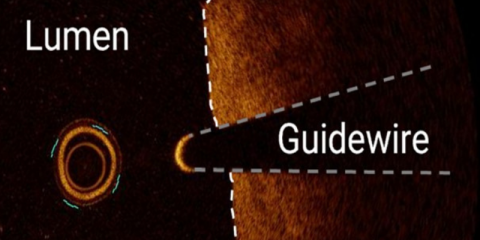 Optical Coherence Tomography for first-time right endovascular treatment