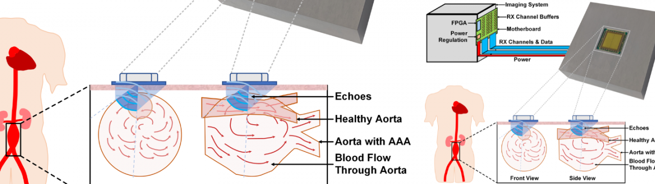 Ultrafast Ultrasound Probe for Improved Diagnosis of Vascular Disease