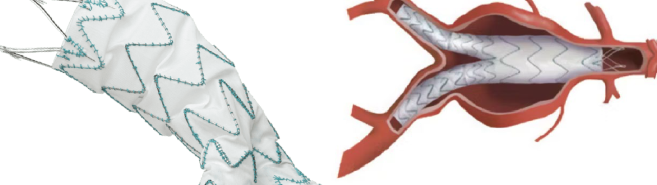 Aneurysm sac Remodeling after EVAR with the TREO Endograft with Machine learning and Imaging Studies