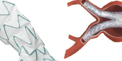 Aneurysm sac Remodeling after EVAR with the TREO Endograft with Machine learning and Imaging Studies