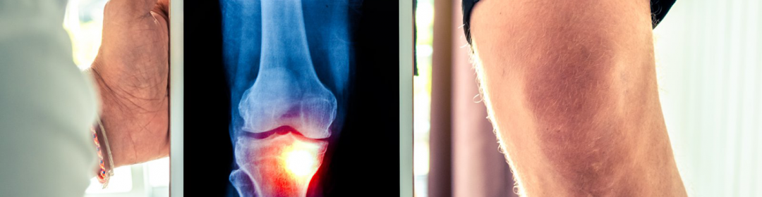 NWO launches call on early detection of osteoarthritis by KIC and Dutch Arthritis Society 