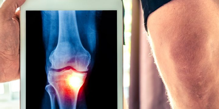 NWO launches call on early detection of osteoarthritis by KIC and Dutch Arthritis Society 
